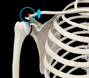 ac-joint-dislocation
