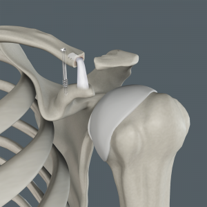 AC joint Resconstruction