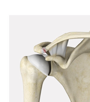 AC Joint Separation