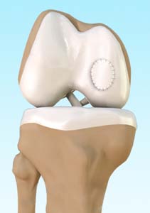 Autologous Chondrocyte Implantation