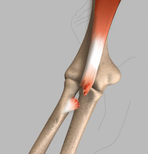 bicep-tendon-rupture