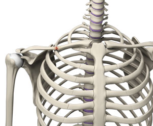 Clavicle Fracture