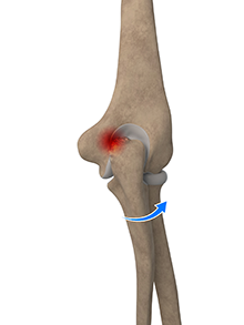 Elbow Impigment