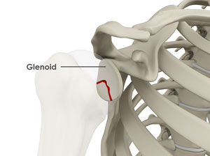 Glenoid Fractures