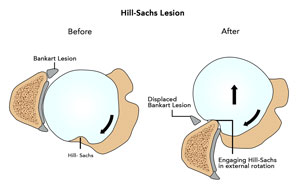 Hill-Sachs Lesion