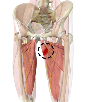 Hip Adductor Injuries Orland Park, IL  Groin Strain Treatment Orland Park,  IL