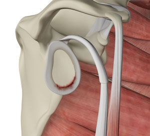 Shoulder Labral Tear