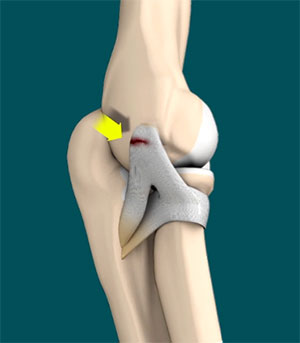 Lateral Ulnar Collateral Ligament Injuries (Elbow)