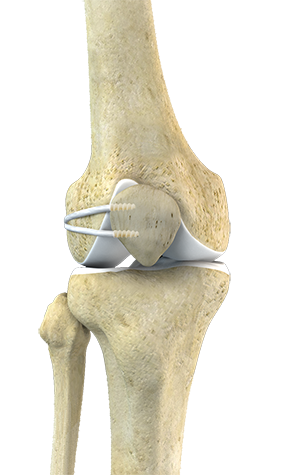 LPFL Reconstruction