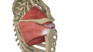 Massive Retracted Rotator Cuff Tear