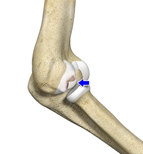 Osteochondritis Dissecans of Elbow