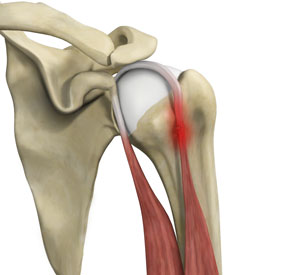 Proximal Biceps Tendinitis