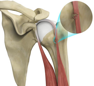 Proximal Biceps Tendon Rupture