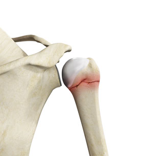 proximal-humerus-fractures