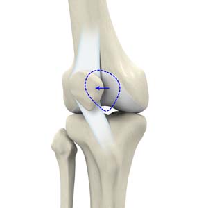Partially dislocated hot sale kneecap recovery time