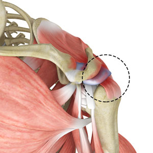 rotator-cuff-pain