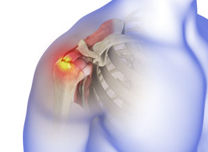 Rotator Cuff Tear