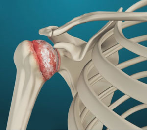 shoulder-arthritis