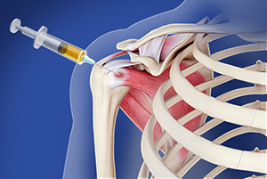 Intraarticular Shoulder Injection