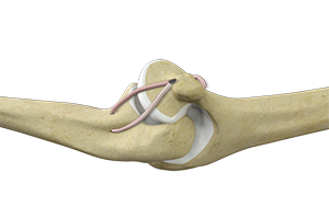 Ulnar Collateral Ligament (UCL) Injury/Tear