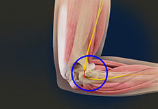 Cubital Tunnel Syndrome (Ulnar Nerve Entrapment)